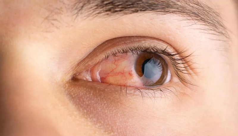 सावधान : वायु प्रदूषण से हो सकता है आंखों को नुकसान..