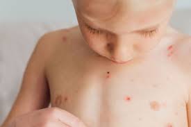 सेहत: खांसने और छींकने से भी फैल सकता है चिकनपॉक्स का ये नया वेरिएंट