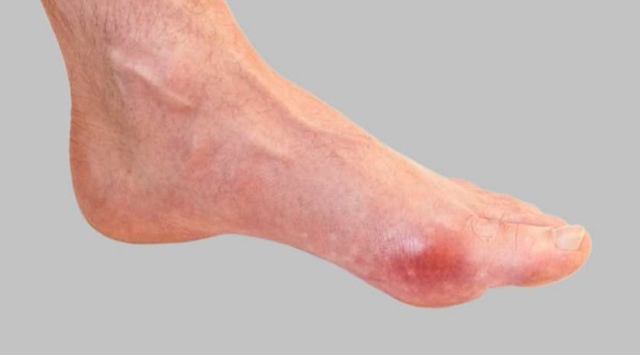 इस मसाले की गर्मी से पिघल जाएगा शरीर में जमा प्यूरिन