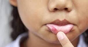  मुंह के छाले जल्दी ठीक करने के उपाय 