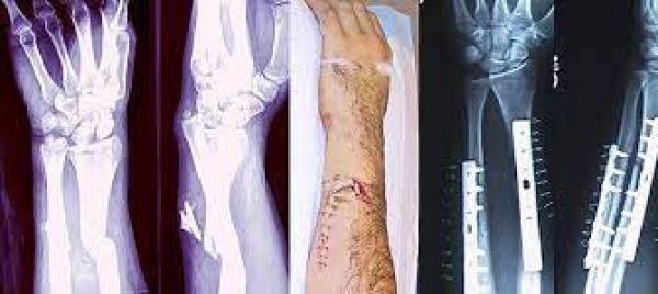 Underlying health issues linked to poor outcomes after fracture in older adults: Study