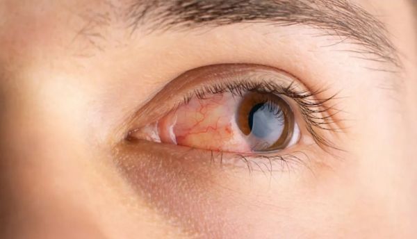 सावधान : वायु प्रदूषण से हो सकता है आंखों को नुकसान..