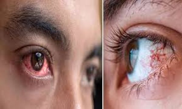 आई फ्लू क्या है? जानें इसके लक्षण, कारण, बचाव और इलाज