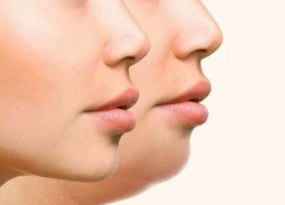 सेहत : फेस फैट