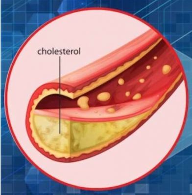 सेहत : नसों में जमे गंदे कोलेस्ट्रॉल को साफ करेगा ये सुपरफूड