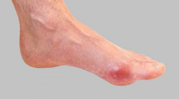 इस मसाले की गर्मी से पिघल जाएगा शरीर में जमा प्यूरिन