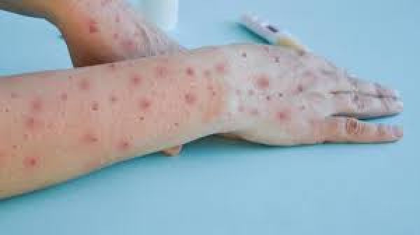 सेहत: खांसने और छींकने से भी फैल सकता है चिकनपॉक्स का ये नया वेरिएंट
