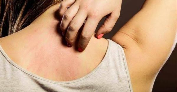 घमौरियों से निजात दिलाएंगे ये घरेलू नुस्खे