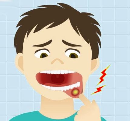 मुंह में सफेद छाले: कारण और समाधान