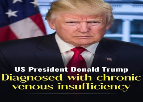 अमेरिकी राष्ट्रपति को क्रोनिक वेनस इनसफिशिएंसी की पुष्टि, अन्य स्वास्थ्य रिपोर्ट सामान्य