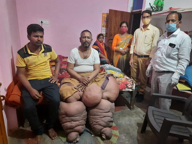 फाइलेरिया से बचाव के लिए हर व्यक्ति दवा खाए : डीएमओ -फाइलेरिया मरीज की आपबीती हर स्वस्थ व्यक्ति के लिए एक सबक