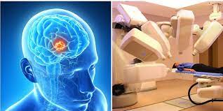 अब ला-इलाज नहीं रहे बिनाइन और मैलिग्नेंट ब्रेन ट्यूमर्स, नई तकनीक से संभव हुआ सफल इलाज