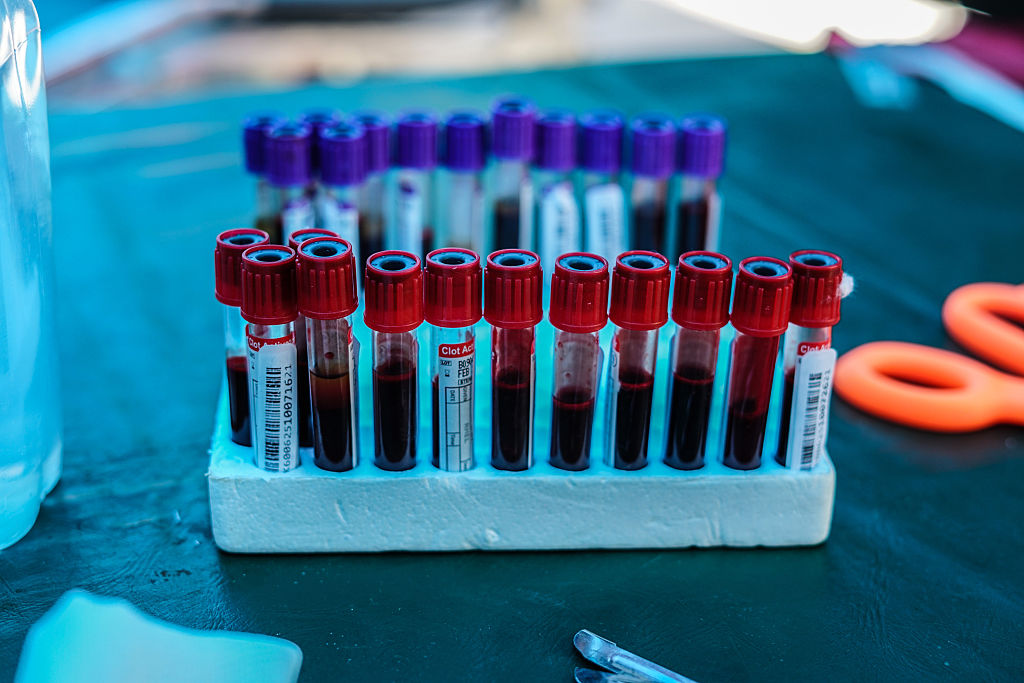 नए रक्त परीक्षण से फेफड़ों के कैंसर का वास्तविक समय में पता लगाया जा सकता है और उसकी निगरानी की जा सकती है।