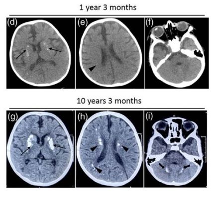 भारतीय वैज्ञानिकों ने बच्चों में पाया दुर्लभ USP18 जीन म्यूटेशन, दुनिया में पहला ऐसा मामला